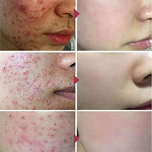 ADILAIDUN Kozmetikai napi szükségletek,Facialmask 有效去除霜淡化斑